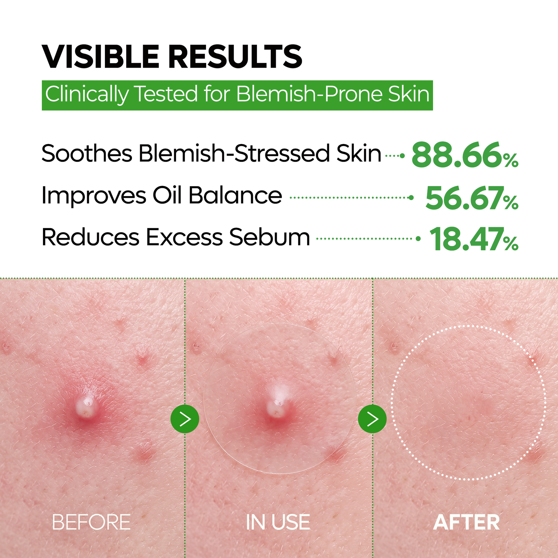 S-ZINC ZERO FIT Ultra Thin Blemish Spot Patch